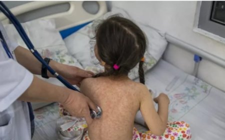 বাংলাদেশের হামের প্রকোপ, ২১ শিশুর মৃত্যু