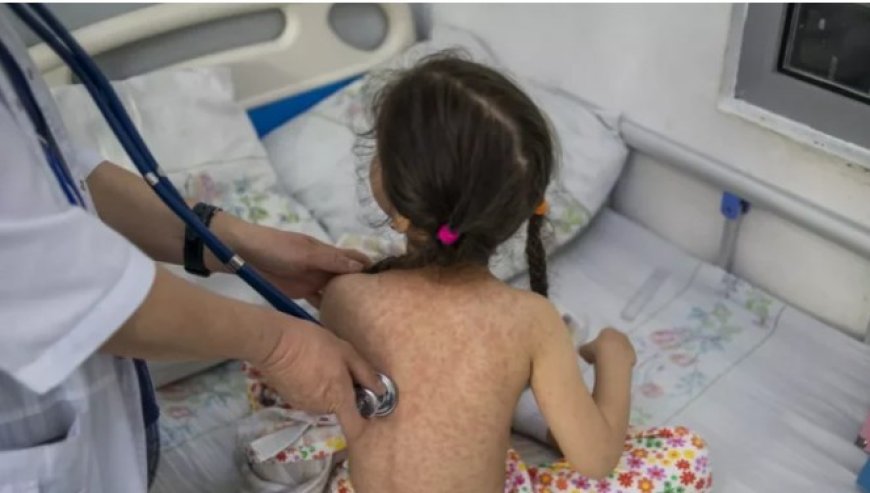 বাংলাদেশের হামের প্রকোপ, ২১ শিশুর মৃত্যু