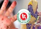 হাম ও হামের উপসর্গে আরও ১৭ শিশুর মৃত্যু