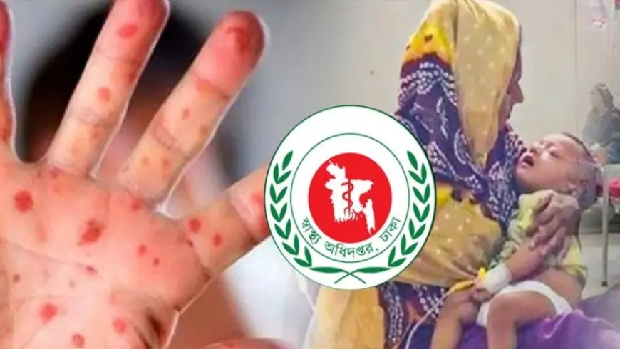 হাম ও হামের উপসর্গে আরও ১৭ শিশুর মৃত্যু